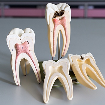 Model of a health tooth and tooth in need of root canal therapy