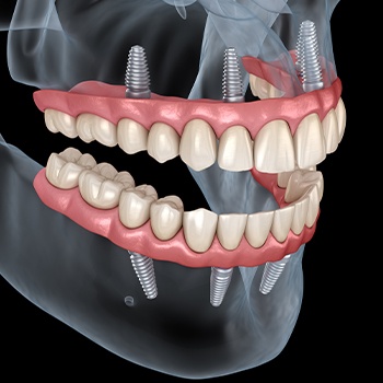 Animated smile with dental implant retained dentures