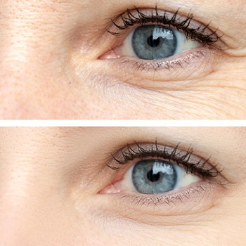 a photo showing the results of BOTOX before and after treatment