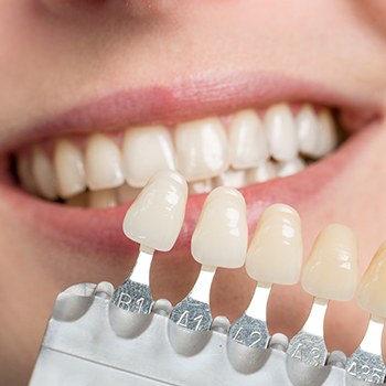 Closeup of smile compared with porcelain veneer color chart