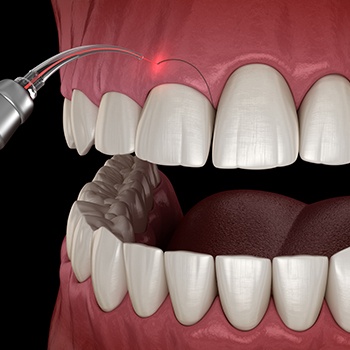 Animated smile during gum recontouring