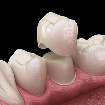Digital illustration of a dental crown