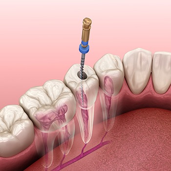 Illustration of root canal treatment in lower arch
