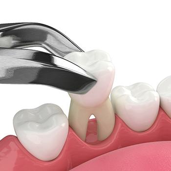 Illustration of tooth extraction in lower arch