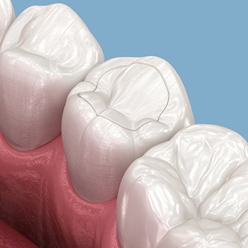 A 3D illustration of a tooth-colored filling
