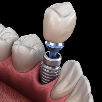 Animated dental implant supported dental crown placement