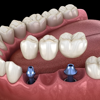 Animated dental implant supported fixed bridge placement