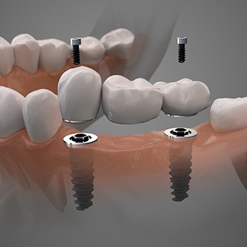 Animated parts of a dental implant supported fixed bridge restoration
