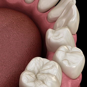 Aniamted smile with crowded teeth