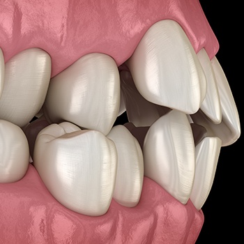 Animated smile with bite alignment issues