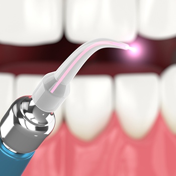 Animated smile and soft tissue laser tool