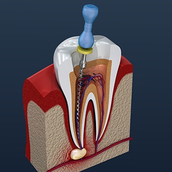 Animated tooth during root canal therapy