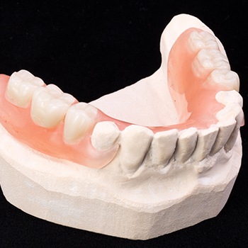 Model smile with partial denture