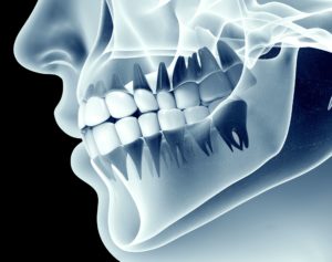 Grayscale x-ray style image of a jaw with teeth