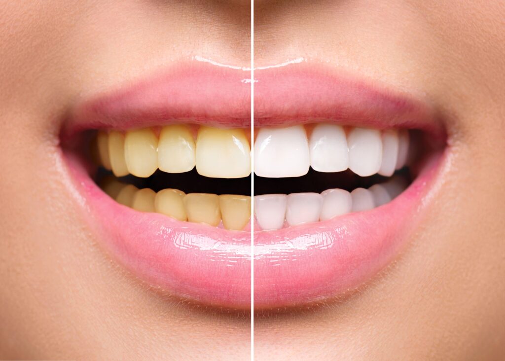 Closeup of woman's smile that's half whitened