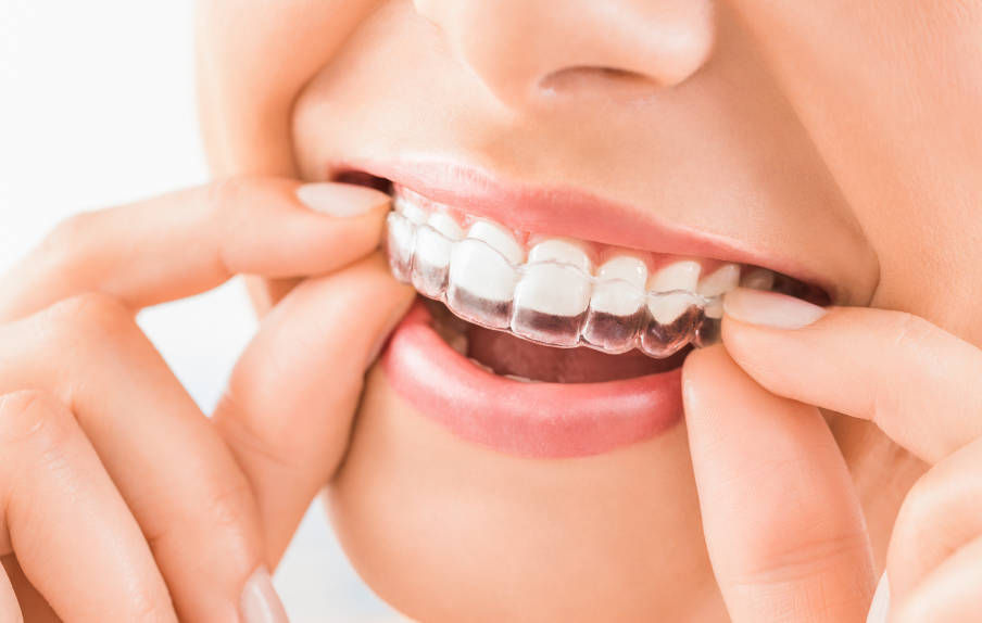 Woman fitting clear aligner