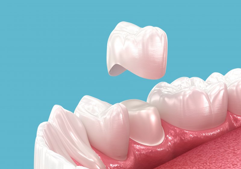 an illustration of a dental crown
